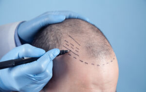 Photo of Hair Transplant: Some Myths and Facts