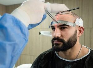 Photo of Hair Transplant Turkey Istanbul If You Want It To Be Good And Cheap