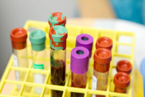Photo of Patient blood management seen to improve health outcomes